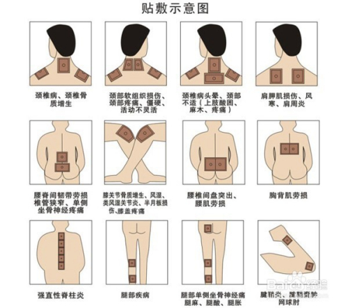 1、肩痛買什么膏藥可以貼？